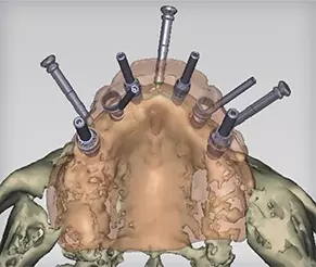 Computer-Guided Surgery