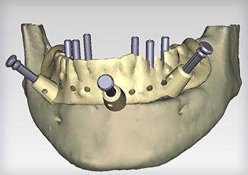 Computer Guided Surgery
