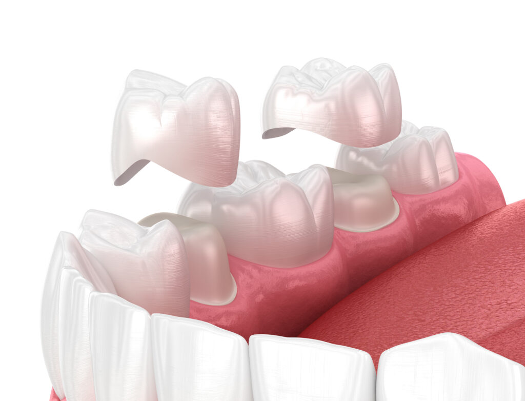 Illustration of dental crowns