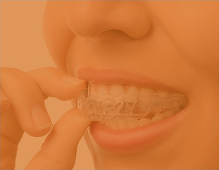 Invisalign