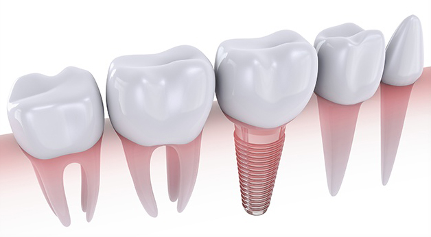 Dental Implants