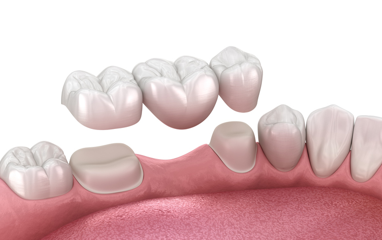 Dental Bridge