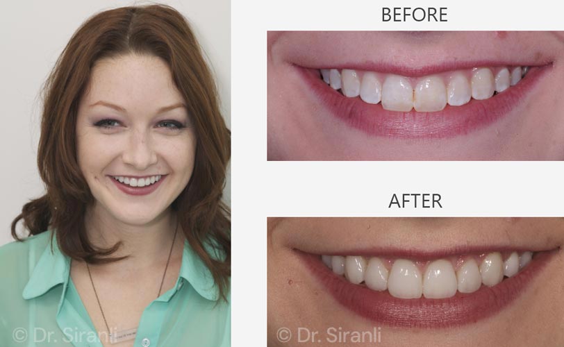 lp-veneers-carousel-01