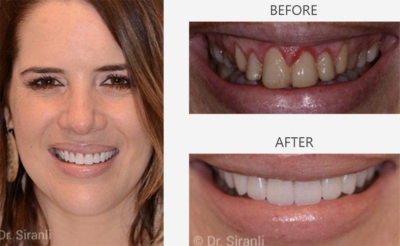 lp-veneers-carousel-02