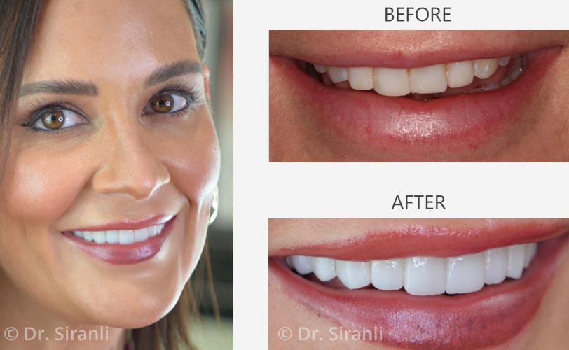 lp-veneers-carousel-03