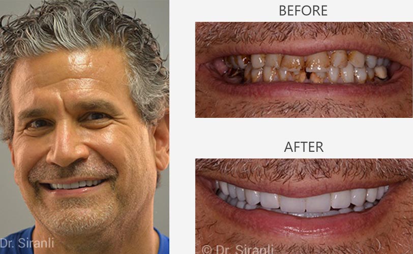 lp-veneers-carousel-04