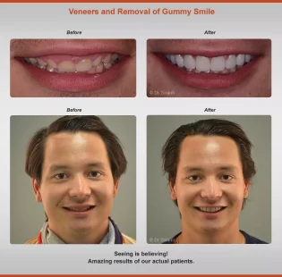 2020-veneer-gum-2