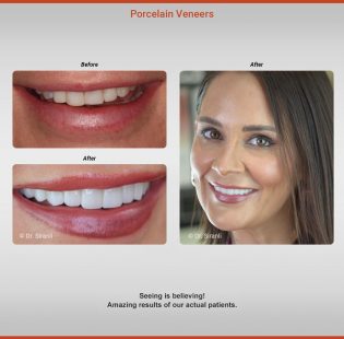 Siranli Porcelain Veneers