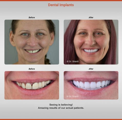 Siranli Dental Implants