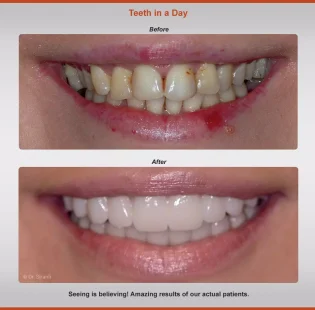 teeth-in-a-day-before-after