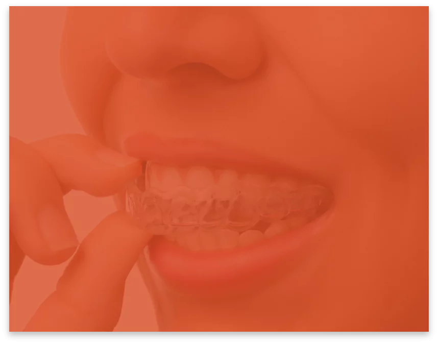 invisalign-service